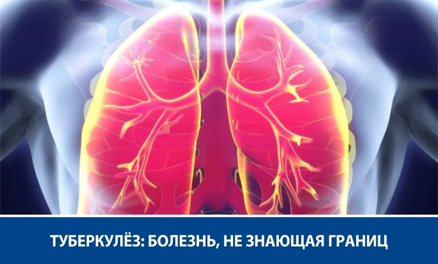 Туберкулез